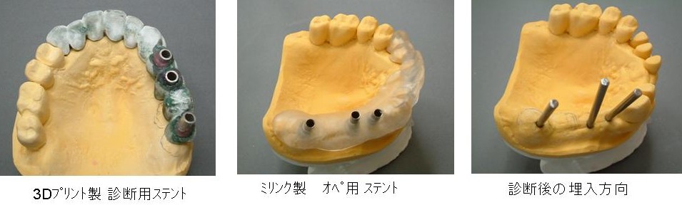 ｽﾃﾝﾄ 診断用 ｵﾍﾟ用